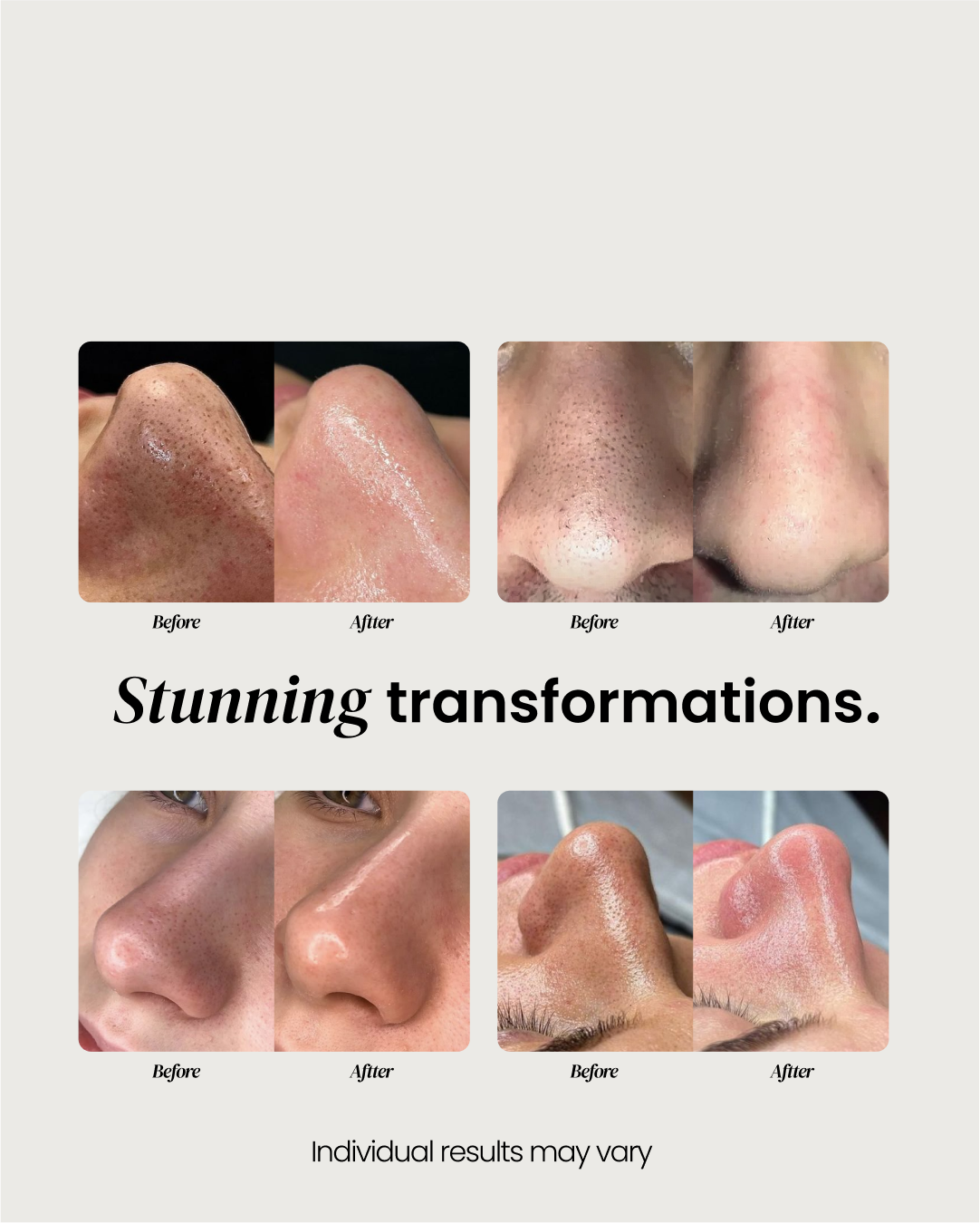 Nose Pimple Patch
